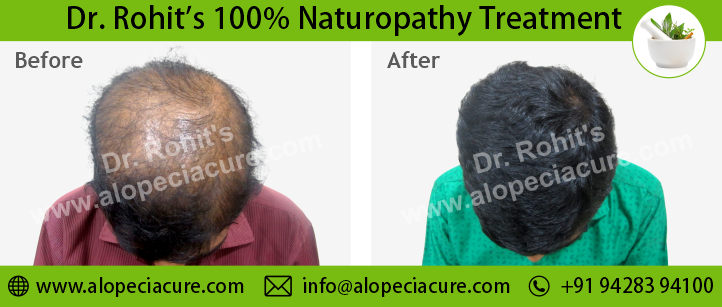 hair loss treatment